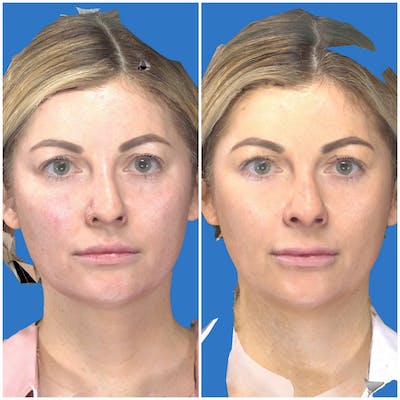 Facelift Before & After Gallery - Patient 14779271 - Image 1