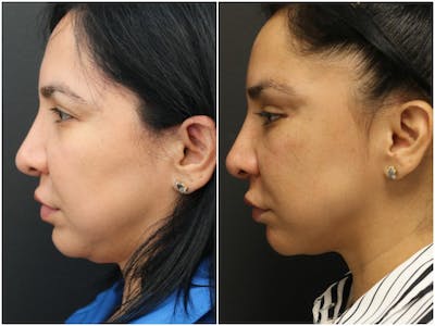 Jawline Filler Before & After Gallery - Patient 14779274 - Image 1