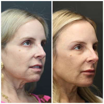 Liquid Facelift Before & After Gallery - Patient 14779277 - Image 1
