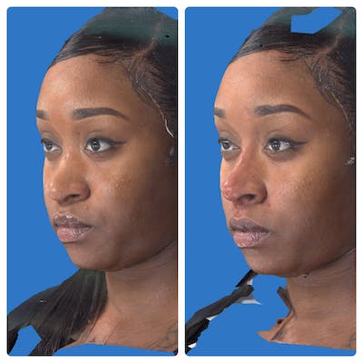 Liquid Rhinoplasty Before & After Gallery - Patient 14779300 - Image 1