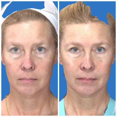 Under Eye Filler Before & After Gallery - Patient 14779342 - Image 1
