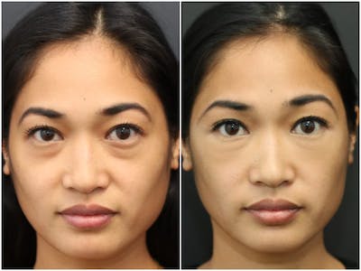 Under Eye Filler Before & After Gallery - Patient 14779345 - Image 1
