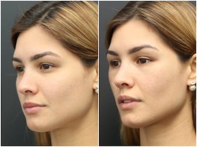 Under Eye Filler Before & After Gallery - Patient 14779346 - Image 1