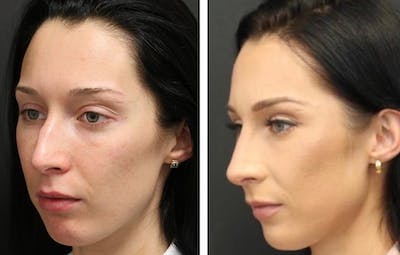 Rhinoplasty Before & After Gallery - Patient 11681676 - Image 1