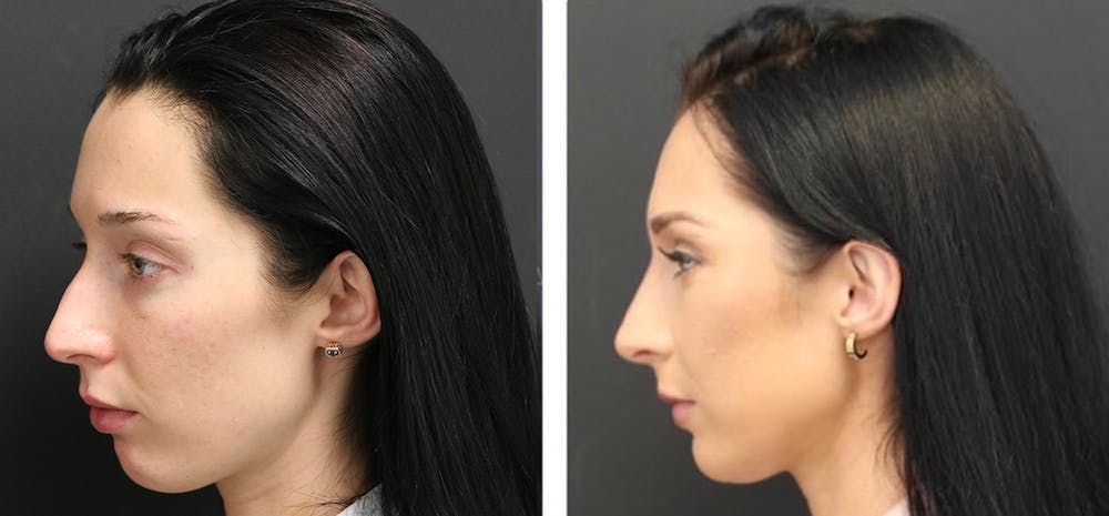 Aesthetic Facial Balancing Before & After Gallery - Patient 11681593 - Image 3