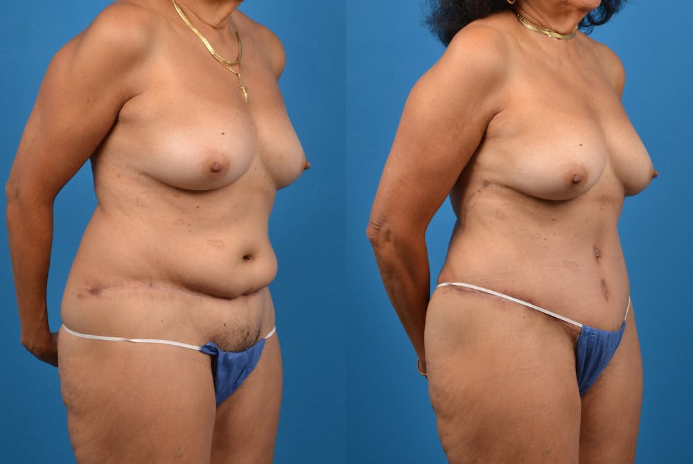 Abdominoplasty Before & After Gallery - Patient 18427841 - Image 5