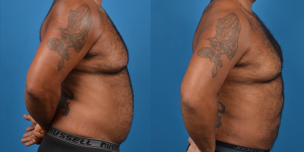 Abdominal Etching Before & After Gallery - Patient 18427898 - Image 4