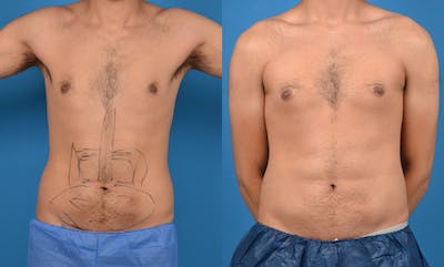 Abdominal Etching Before & After Gallery - Patient 18427899 - Image 1