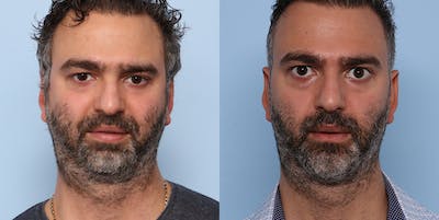 Sliding Genioplasty Before & After Gallery - Patient 121439980 - Image 1