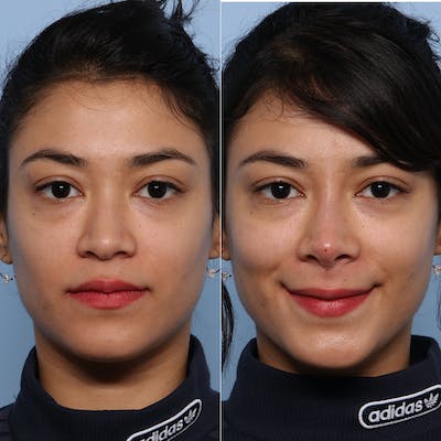 Liquid Rhinoplasty Before & After Gallery - Patient 141495653 - Image 1