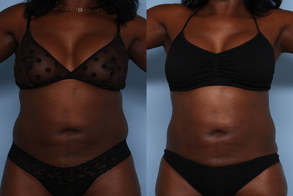 Emsculpt Before & After Gallery - Patient 141495662 - Image 1