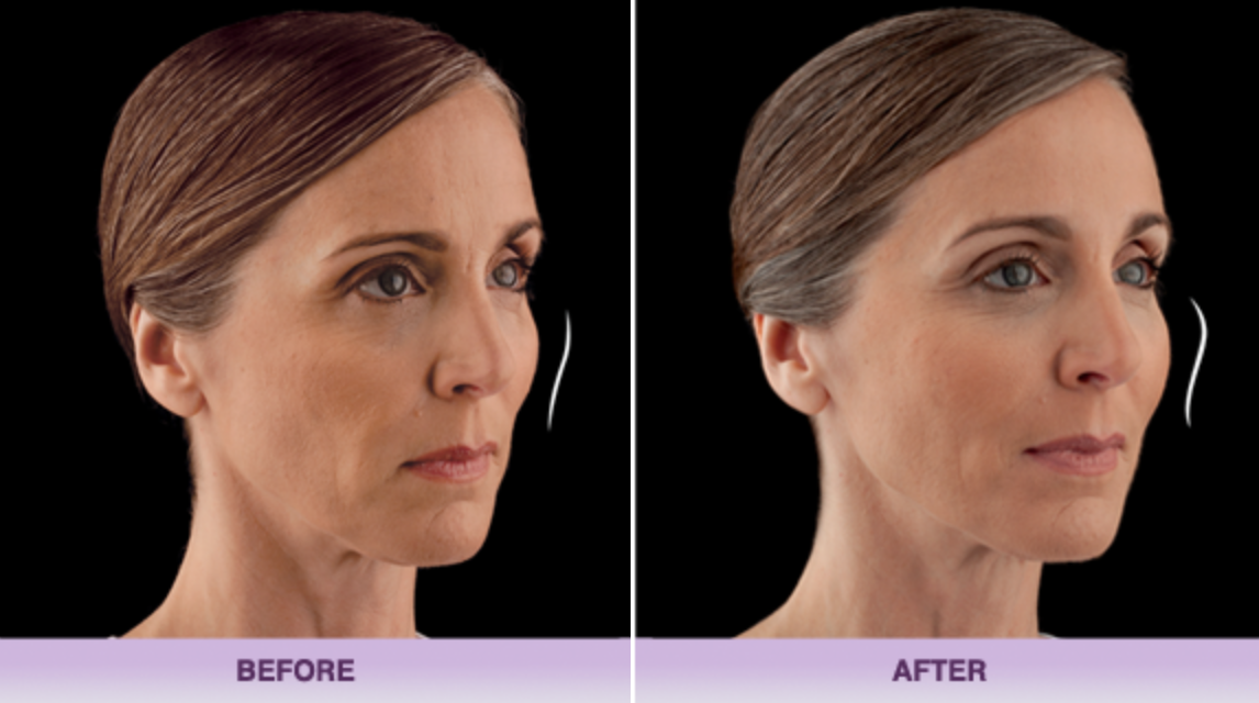 juvaderm-fillers-miami-before-after